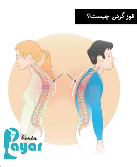 آیا میدانید علت قوز گردن چیست؟