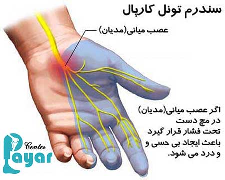 درمان خانگی علائم سندروم تونل کارپال