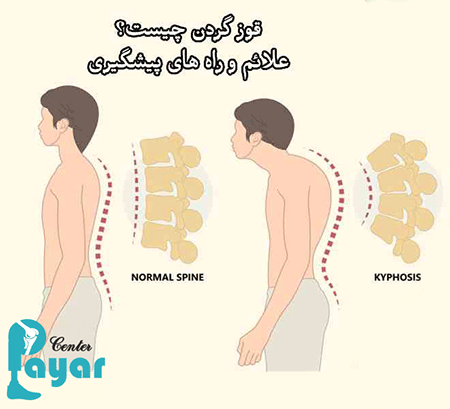 علت قوز گردن