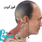 علائم قوز گردن چیست؟🌟چگونه پیشگیری کنیم؟