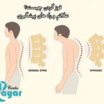 علت قوز گردن چیست؟🌟چگونه درمان می شود؟