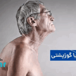 عوارض قوز کمر چیست؟🌟آن را جدی بگیرید!