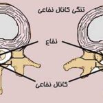 اگر تنگی کانال نخاعی درمان نشود چه میشود؟🌟جدی بگیرید