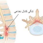 تنگی کانال نخاعی چیست؟🌟و چگونه ایجاد میشود؟