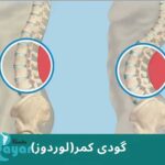 عوارض لوردوز کمری چیست؟🌟 عوارض گودی کمر