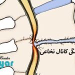 چگونه بفهمیم تنگی کانال نخاع داریم؟